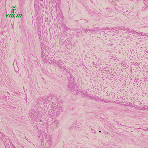 海南人口腔病理标本片