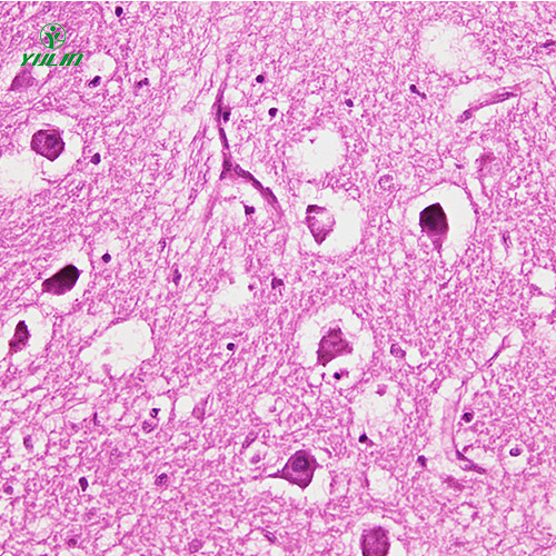 海南人神经系统疾病标本片