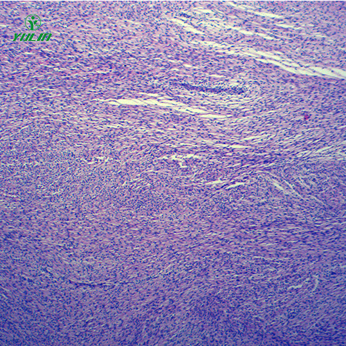 海南人体肿瘤病理玻片
